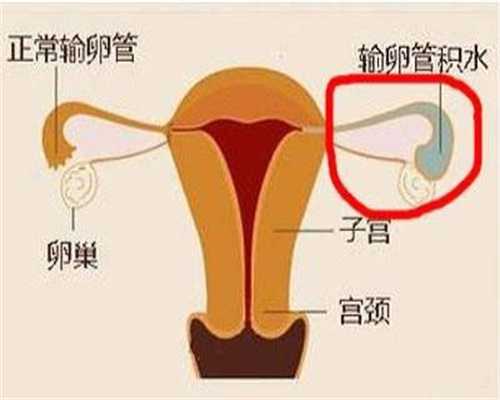 单侧输卵管堵塞能代孕吗 代孕几率有多大